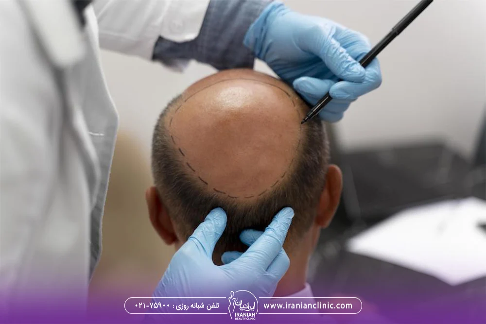 عکس پشت سر فردی که دچار طاسی است و پزشک موی سر او را معاینه می کند