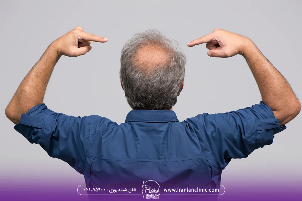 عکس یک مرد میانسال از پشت سر که با دو دست به ناحیه طاسی سر خود اشاره می کند - درمان ریزش مو مردان