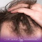 عکس یک مرد که ریزش مو شدید دارد و موهای خود را در دست گرفته است