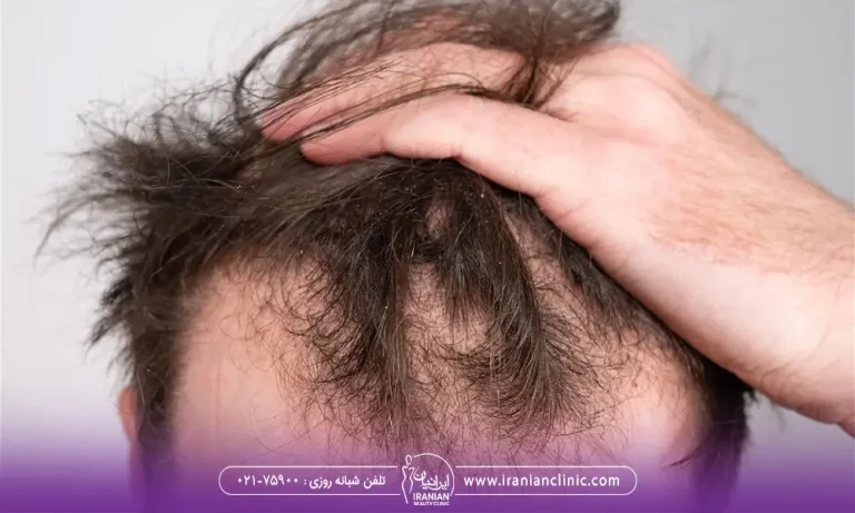 عکس یک مرد که ریزش مو شدید دارد و موهای خود را در دست گرفته است