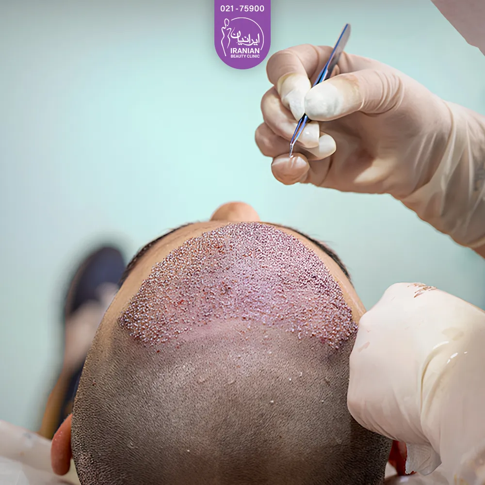 عکس پزشک که گرافت های مو را به جلوی سر مراجعه کننده مرد پیوند می زند - کاشت مو میکرو گرافت