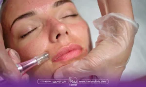 عکس میکرونیدلینگ خط خنده زن جوان - بهترین مرکز میکرونیدلینگ در تهران