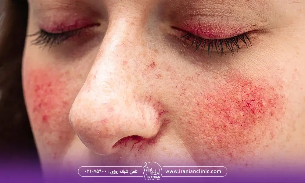 عکس قرمزی پوست روی گونه ها و بینی - عوارض اندولیفت