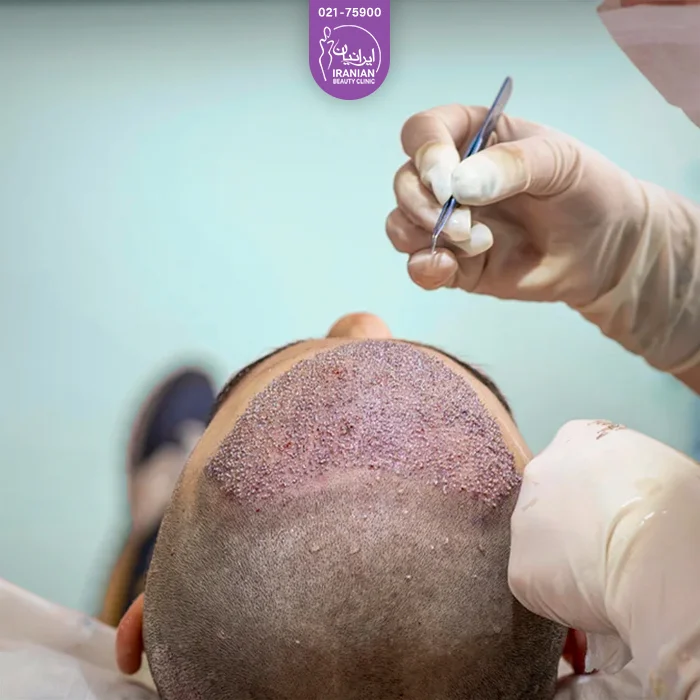 پزشک در حال پیوند گرافت های مو به ناحیه جلوی سر مراجعه کننده - کاشت مو به روش sut
