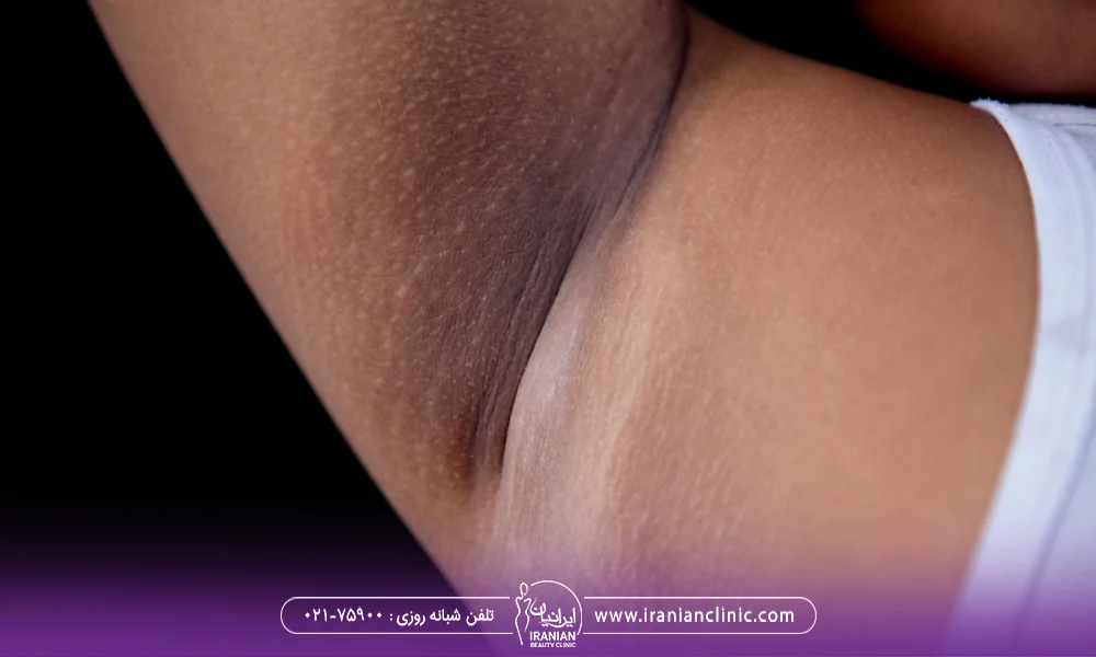 عکس پوست زیر بغل که بعد از لیزر دچار تیرگی شده است
