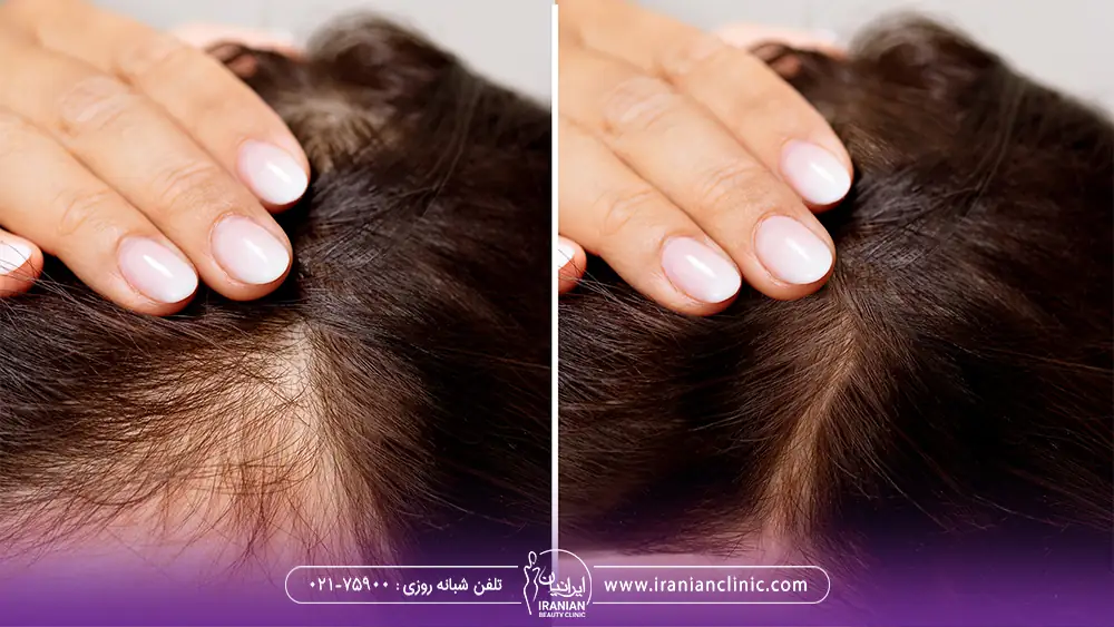 عکس قبل و بعد درمان ریزش مو زنان