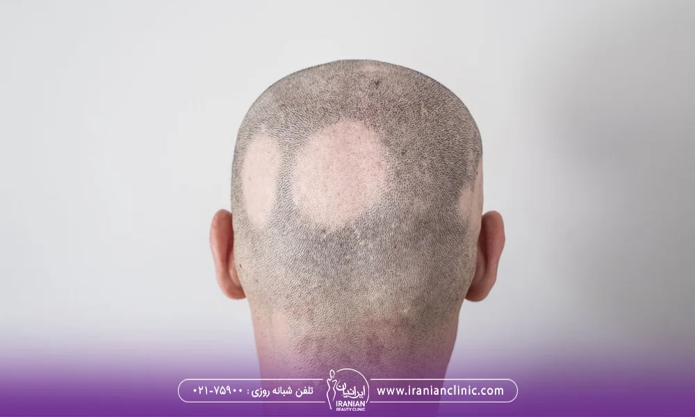 عکس ریزش مو سکه ای - درمان ریزش مو زنان