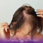 عکس زنی که دچار ریزش مو شدید است - درمان ریزش مو زنان