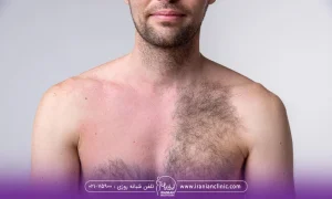 قبل و بعد لیزر کردن سینه یک آقا