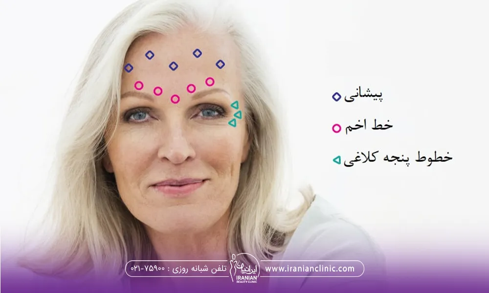 خانمی که موهای سفید دارد و روی صورتش نقاط تزریق بوتاکس پیشانی و خط اخم و پنجه کلاغی مشخص شده است