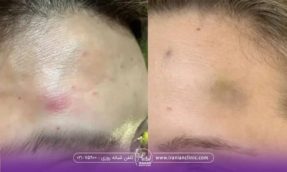 فردی که بوتاکس پیشانی کرده و ورم و کبود شده است
