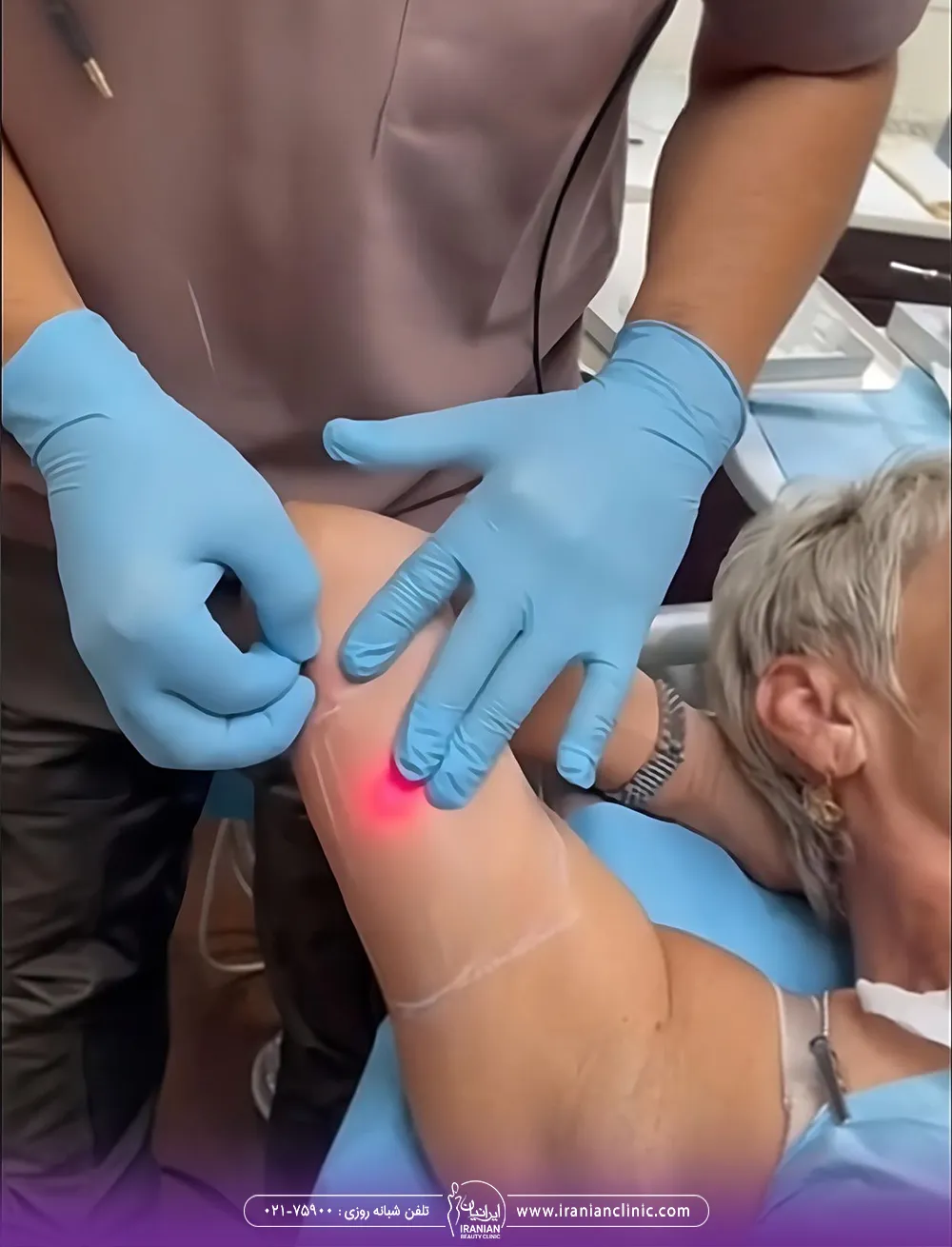 پزشک در حال انجام اندولیفت روی بازوی مراجعه کننده زن - اندولیفت بازو