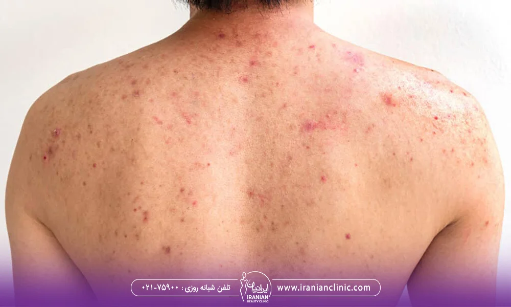کمر و کتف مردی که اسکار آکنه دارد