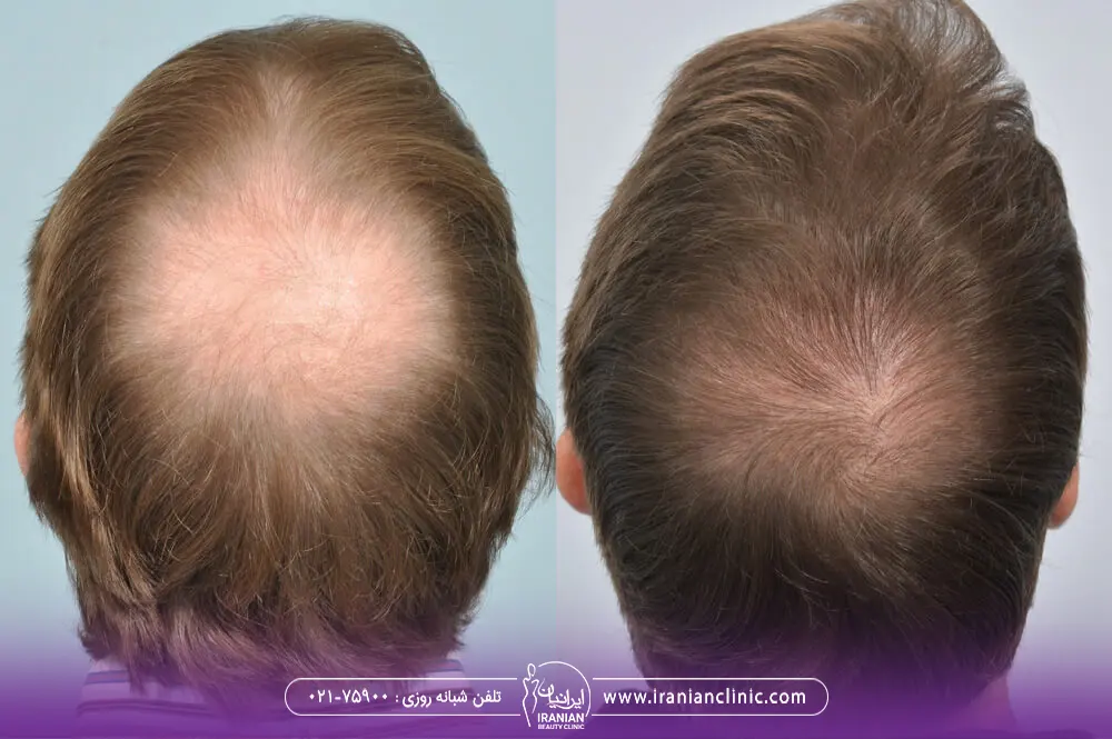 عکس قبل و بعد کاشت مو در فرق سر