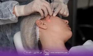 پزشک در حال وارد کردن سری اندولیفت به صورت زن جوان - هزینه اندولیفت