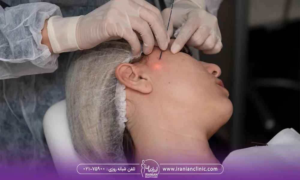 پزشک در حال وارد کردن سری اندولیفت به صورت زن جوان - هزینه اندولیفت
