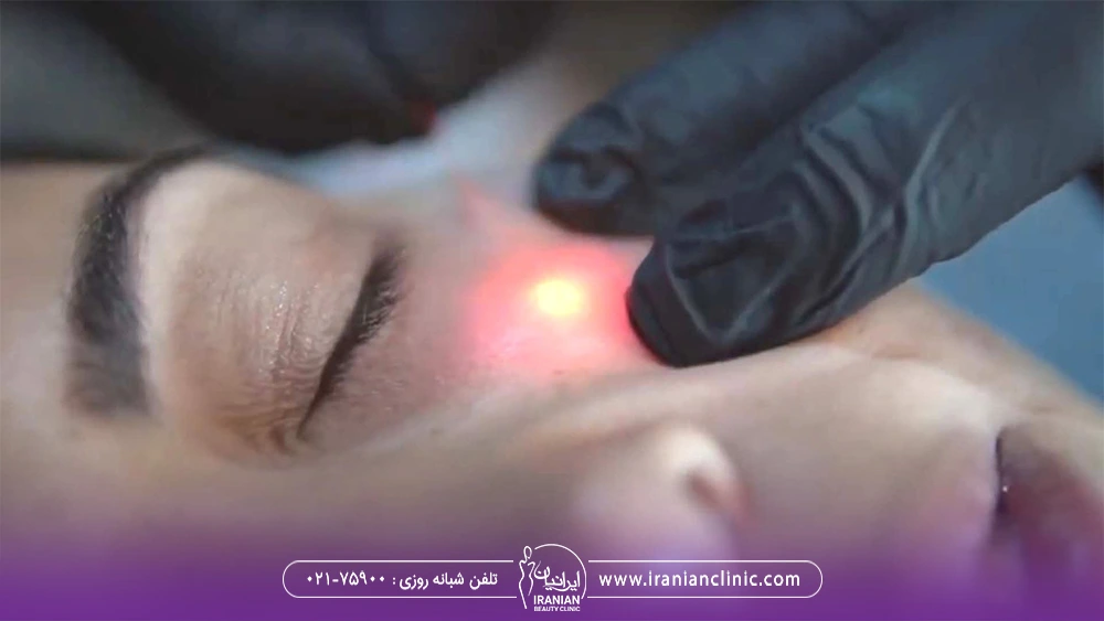 عکس نور لیزر اندولیفت روی گونه زن جوان
