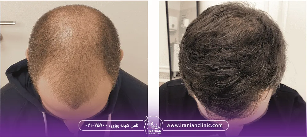 عکس قبل و بعد کاشت مو به روش FUE