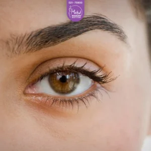 ابروی سمت چپ زن جوان که بسیار ضخیم و پر پشت است - کاشت ابرو fue