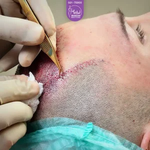 پزشک در حال پیوند گرافت های مو به سر مرد - کاشت مو به روش FUE
