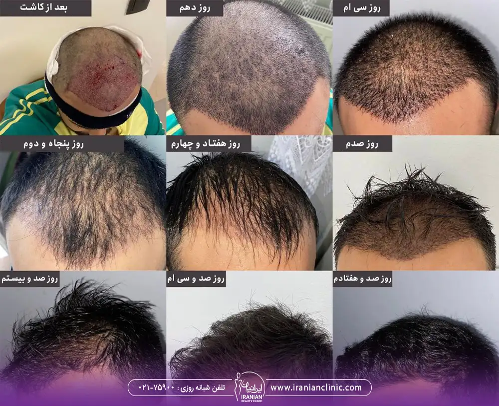 مراحل مختلف کاشت مو از زمان کاشت تا 170 روز بعد