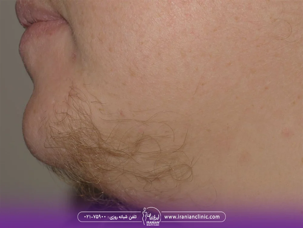 عکس زن مبتلا به هیرسوتیسم