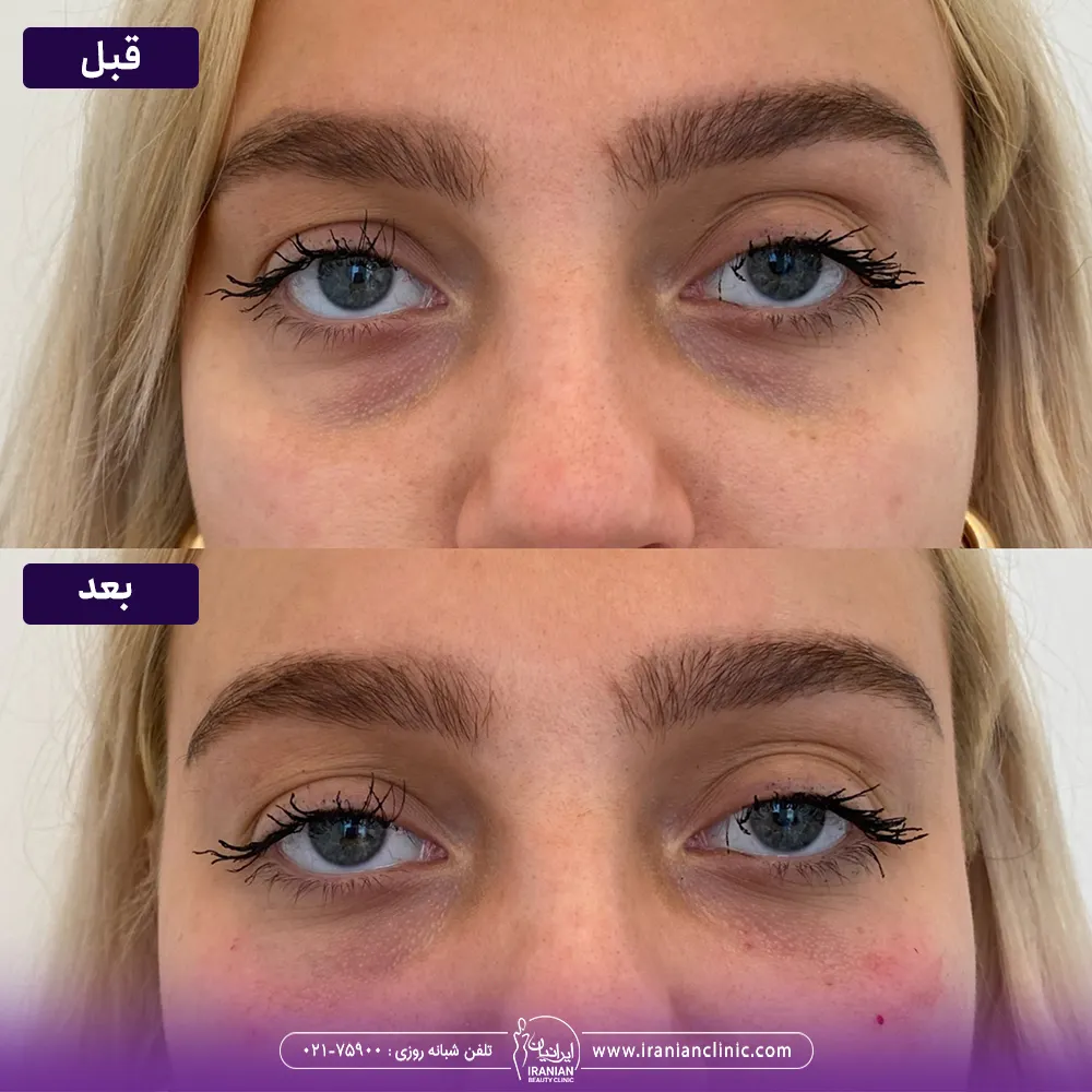 عکس قبل و بعد مزوتراپی زیر چشم و رفع گودی و تیرگی چشم