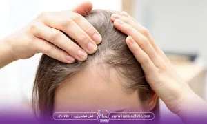 دختر جوان که دچار ریزش موی شدید در جلوی سر است - ریزش مو آندروژنیک