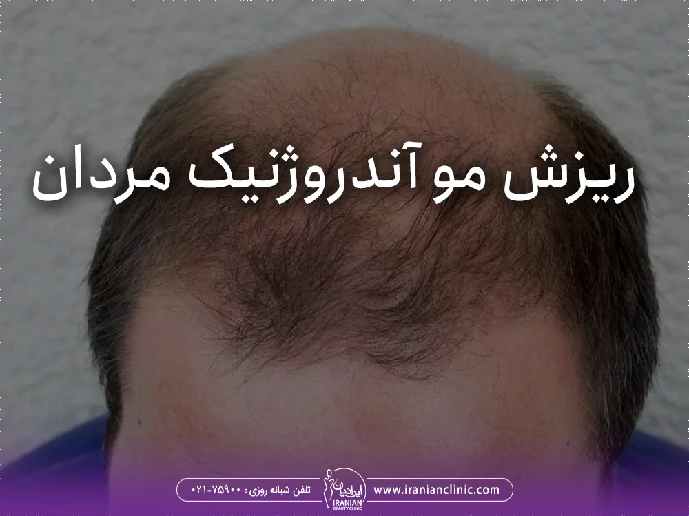 ریزش مو آندروژنیک مردان