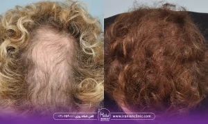 عکسهای کاشت موی خانمها