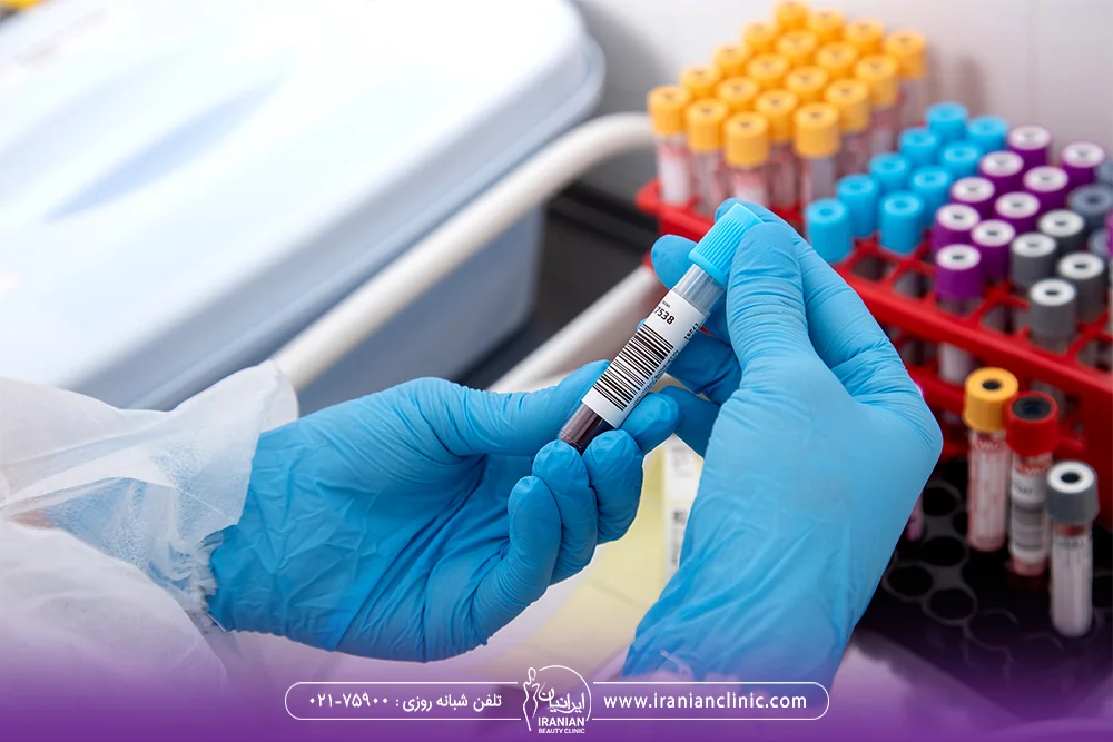 عکس شیشه های آزمایش خون در دست پزشک - آزمایشات لازم قبل از کاشت مو