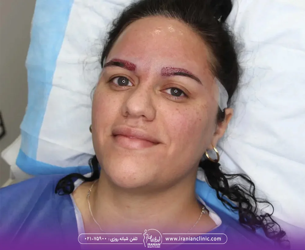 عمل کاشت ابروی زن جوان در یک کلینیک کاشت ابرو