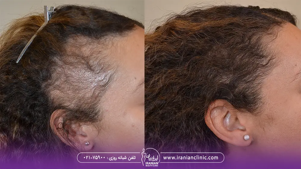 عکس قبل و بعد کاشت موی زن