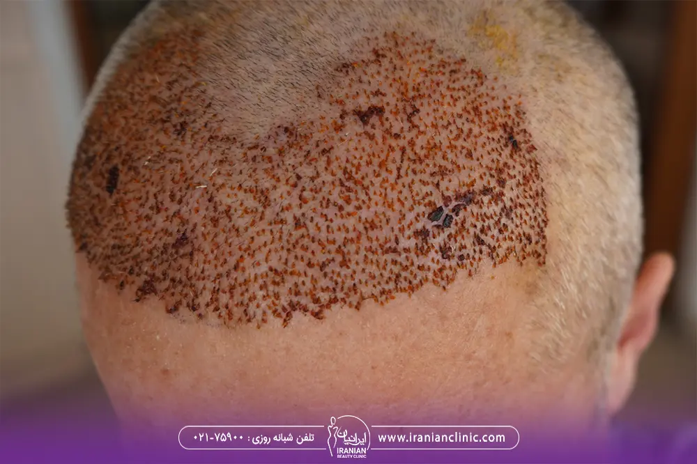 عکس فولیکولیت بعد از کاشت مو - عوارض کاشت مو