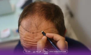 عکس پزشک که با مداد روی پیشانی مرد طاس می کشد