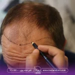 عکس پزشک که با مداد روی پیشانی مرد طاس می کشد