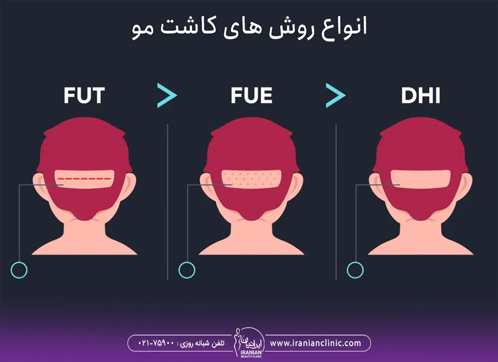 انواع روش های کاشت مو - جدیدترین روش کاشت مو