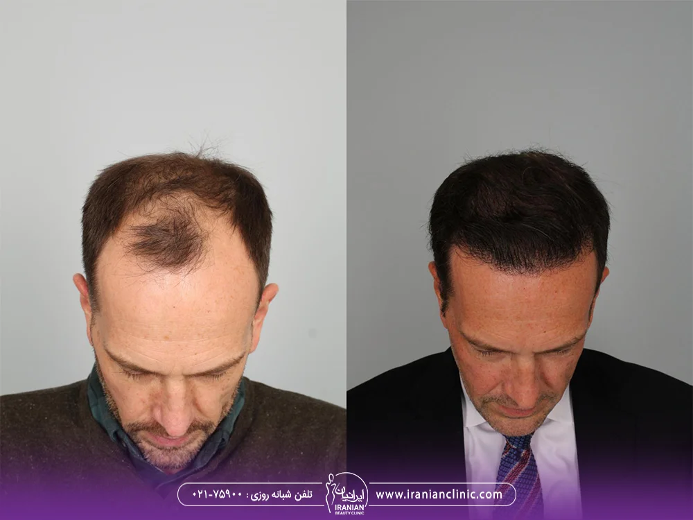 عکس قبل و بعد کاشت مو برای مردان