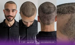 عکس کاشت موی مرد جوان از زوایای مختلف - عوارض کاشت مو