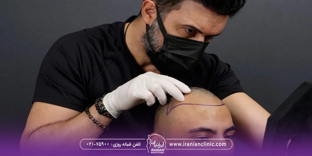 دکتر کاشت مو که ماسک زده و خط رویش را روی سر مراجعه کننده مرد رسم کرده است