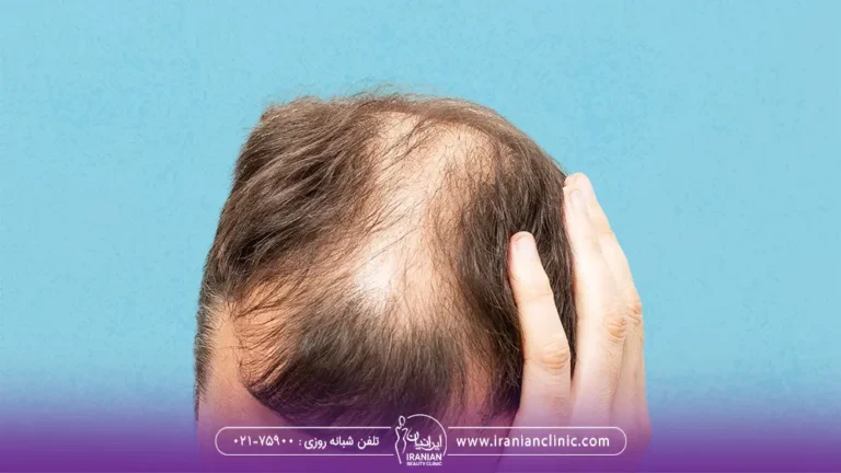 مردی که در وسط سر خود دچار طاسی شده است