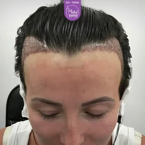عکس مراجعه کننده خانم که خط رویش موی او به سمت عقب رفته است - کاشت مو برای زنان