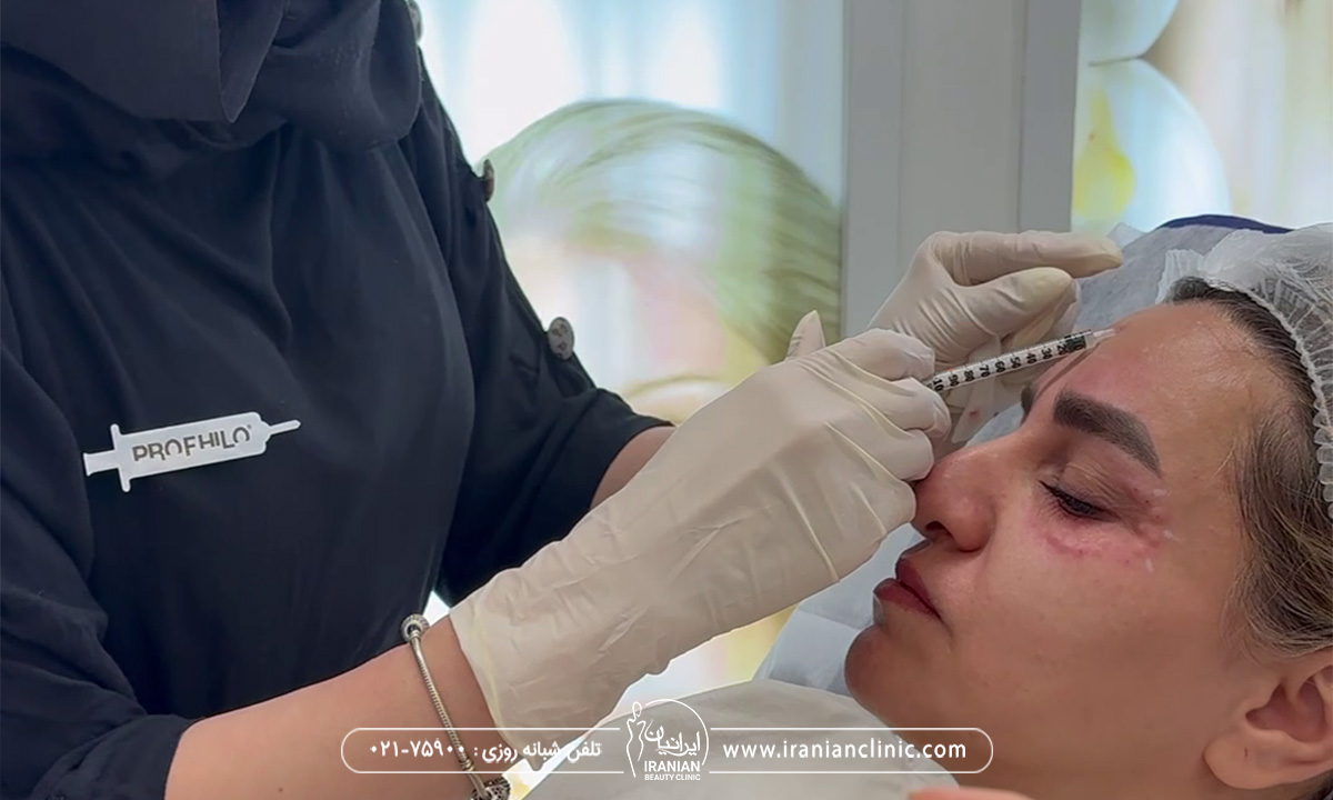 بوتاکس چشم گربه ای