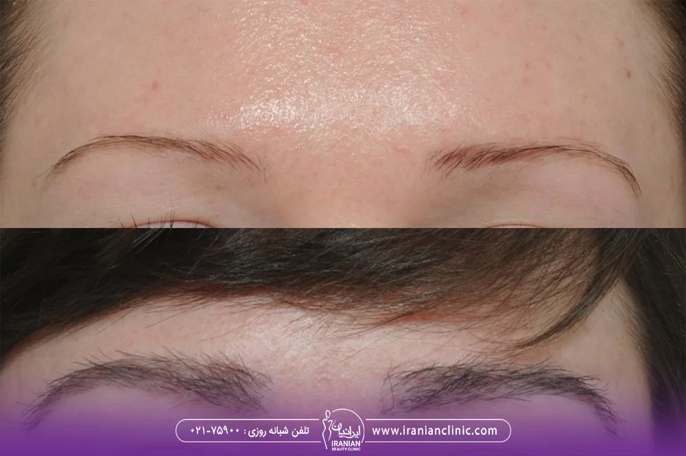 عکس قبل و بعد از پیوند ابرو - هزینه کاشت ابرو