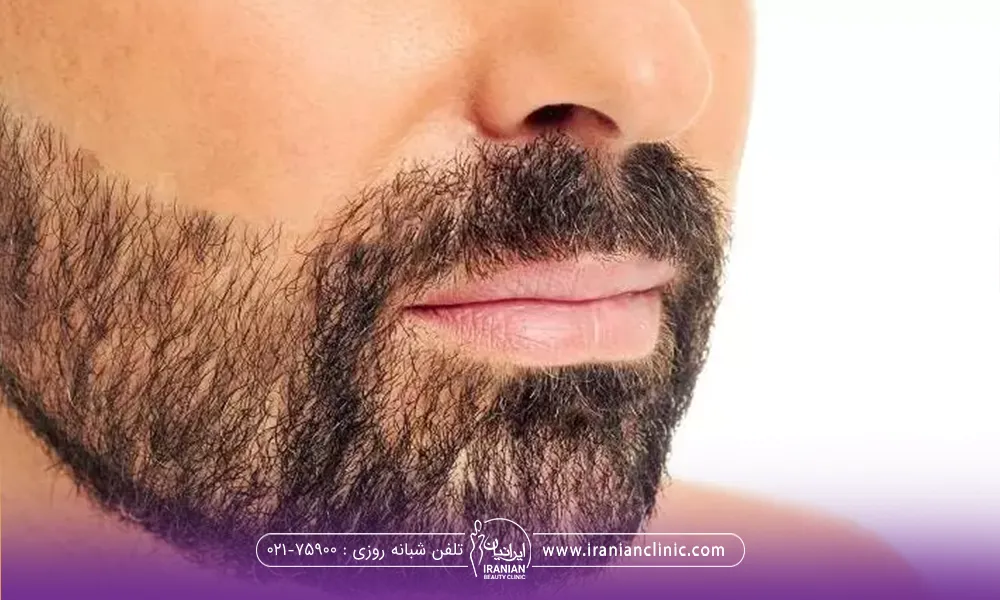 مردی که لیزر خط ریش انجام داده است