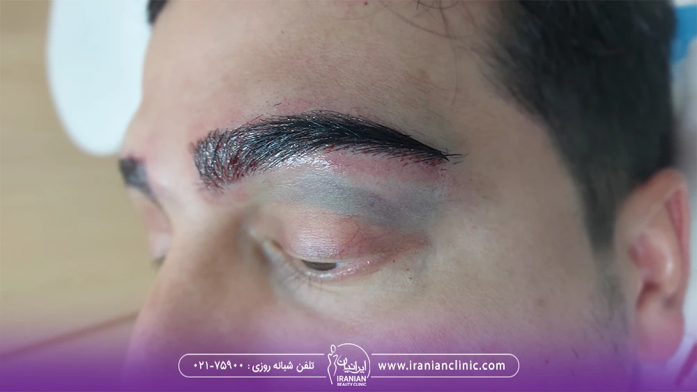 مرد جوان که کاشت ابرو انجام داده است و چشم او ورم کرده است