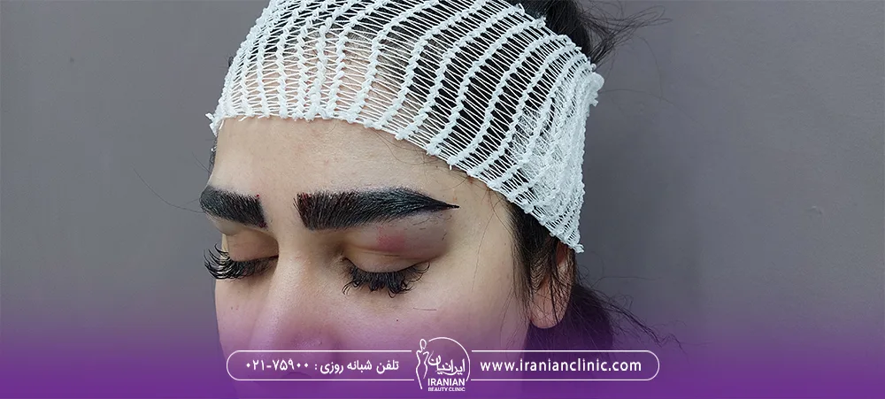 عکس ورم چشم دختر جوان بعد از کاشت ابرو