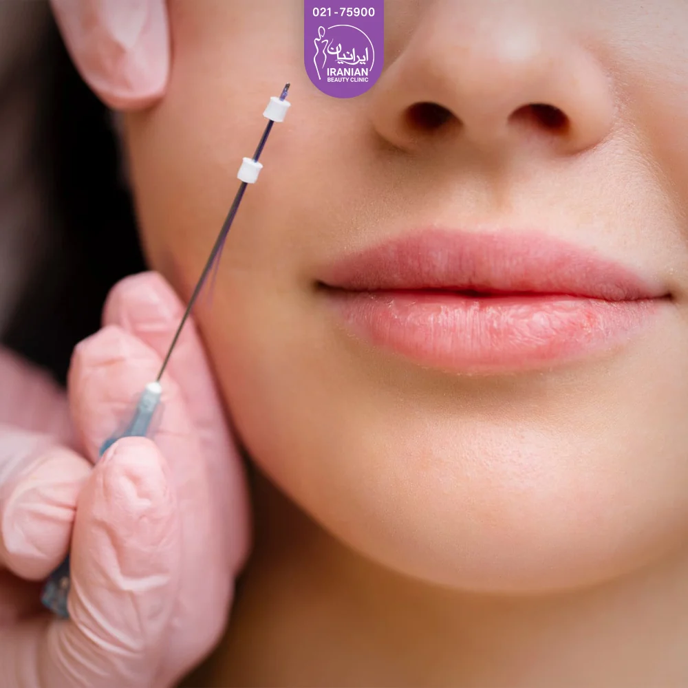 عکس نزدیک از صورت زن جوان که پزشک نخ لیفت را در کنار گونه او گرفته است - زاویه سازی صورت با نخ