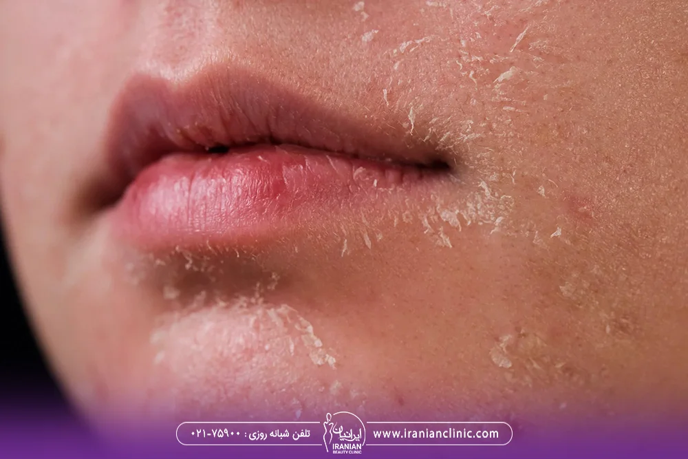 صورت خشک و پوسته پوسته