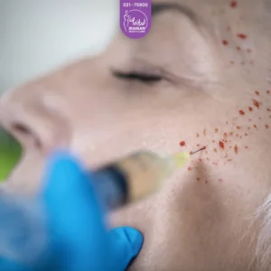 عکس پزشک در حال پی آر پی صورت مراجعه کننده